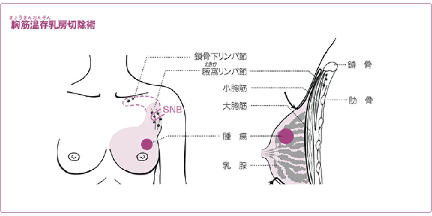 乳がん 手術