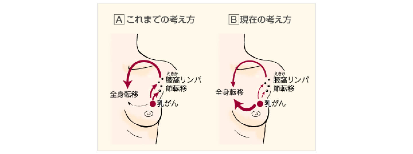 手術 乳がん