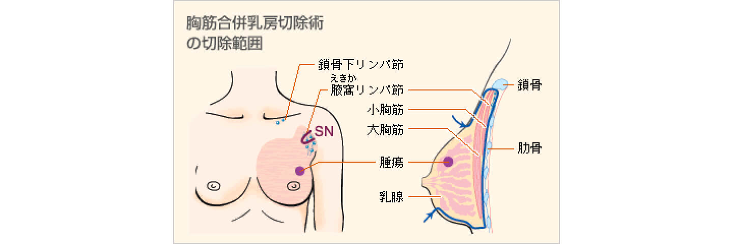 手術 乳がん Q26．手術後の乳房はどのようになりますか。