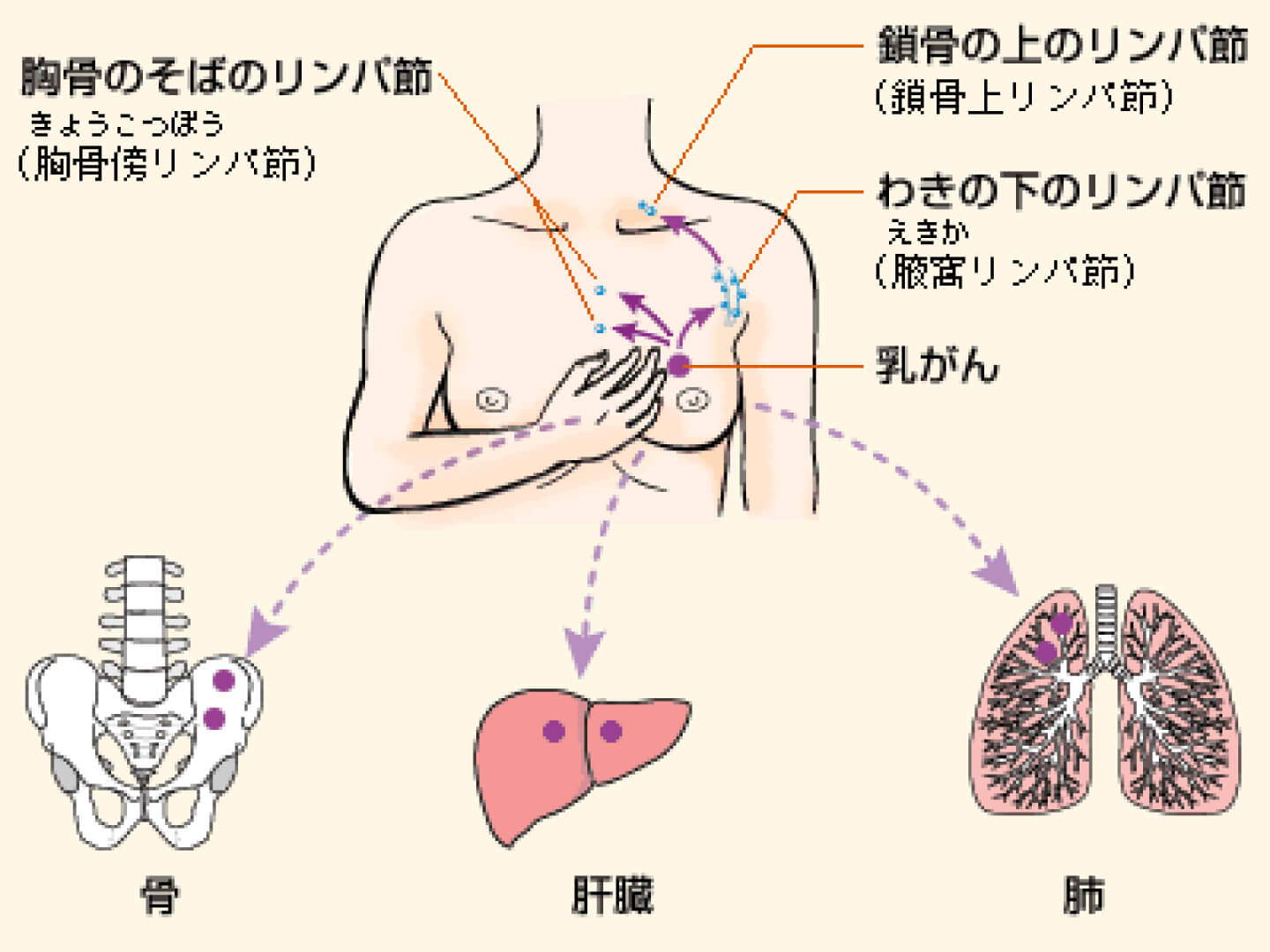 乳がんの進展 | 早期治療の重要性 | 乳がんかもしれないと不安なかた | 乳がん.jp