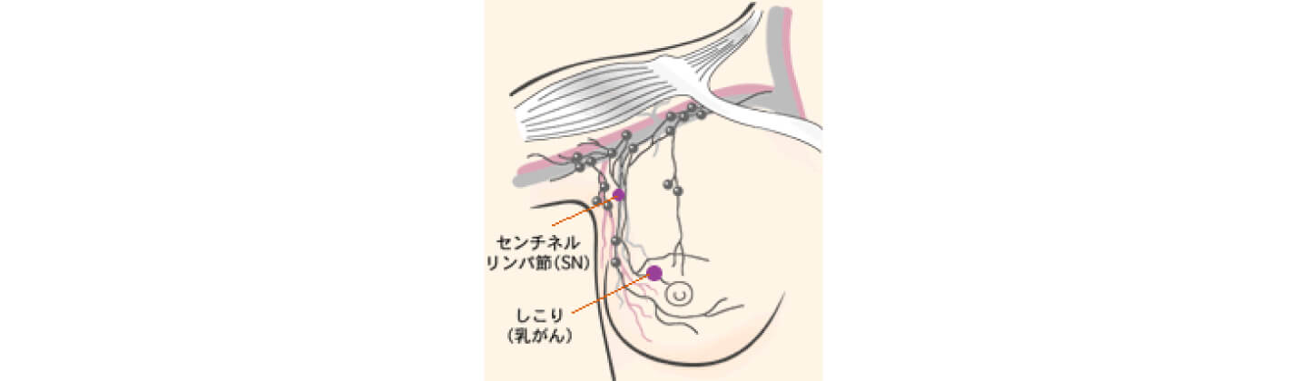 腋窩リンパ節郭清とセンチネルリンパ節生検 | 手術の前に | HER2陽性乳がん | 乳がん.jp