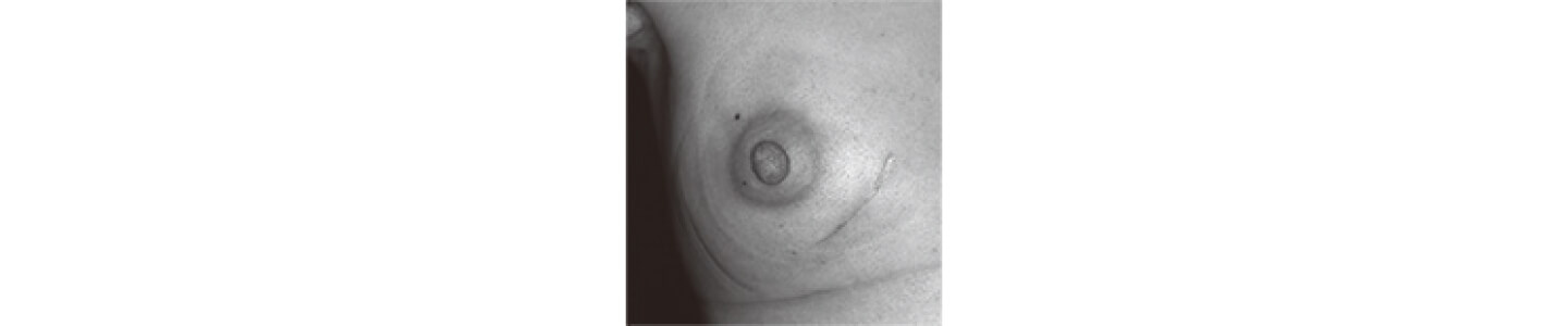 右乳房温存手術後放射線照射後3ヵ月の皮膚の状態 | 乳房温存手術のQ&A | HER2陽性乳がん | 乳がん.jp