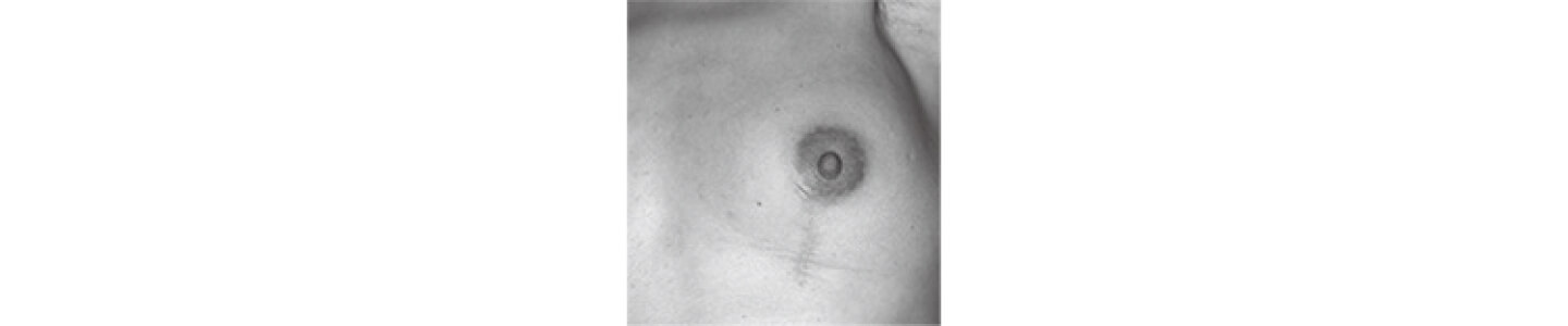 左乳房円状部分切除術後放射線照射５ヵ月後の状態 | HER2陽性乳がん | 乳がん.jp