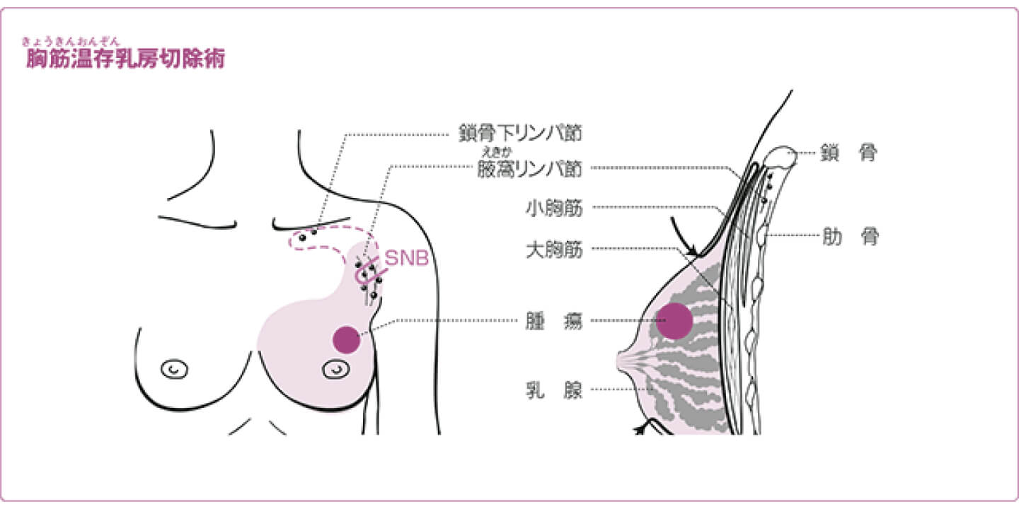 胸筋温存乳房切除術 | 乳房全切除術 | HER2陽性乳がん | 乳がん.jp