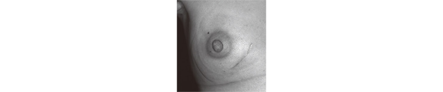 右乳房温存手術後放射線照射後3ヵ月の皮膚の状態 | 乳房温存手術のQ&A | トリプルネガティブ乳がん | 乳がん.jp
