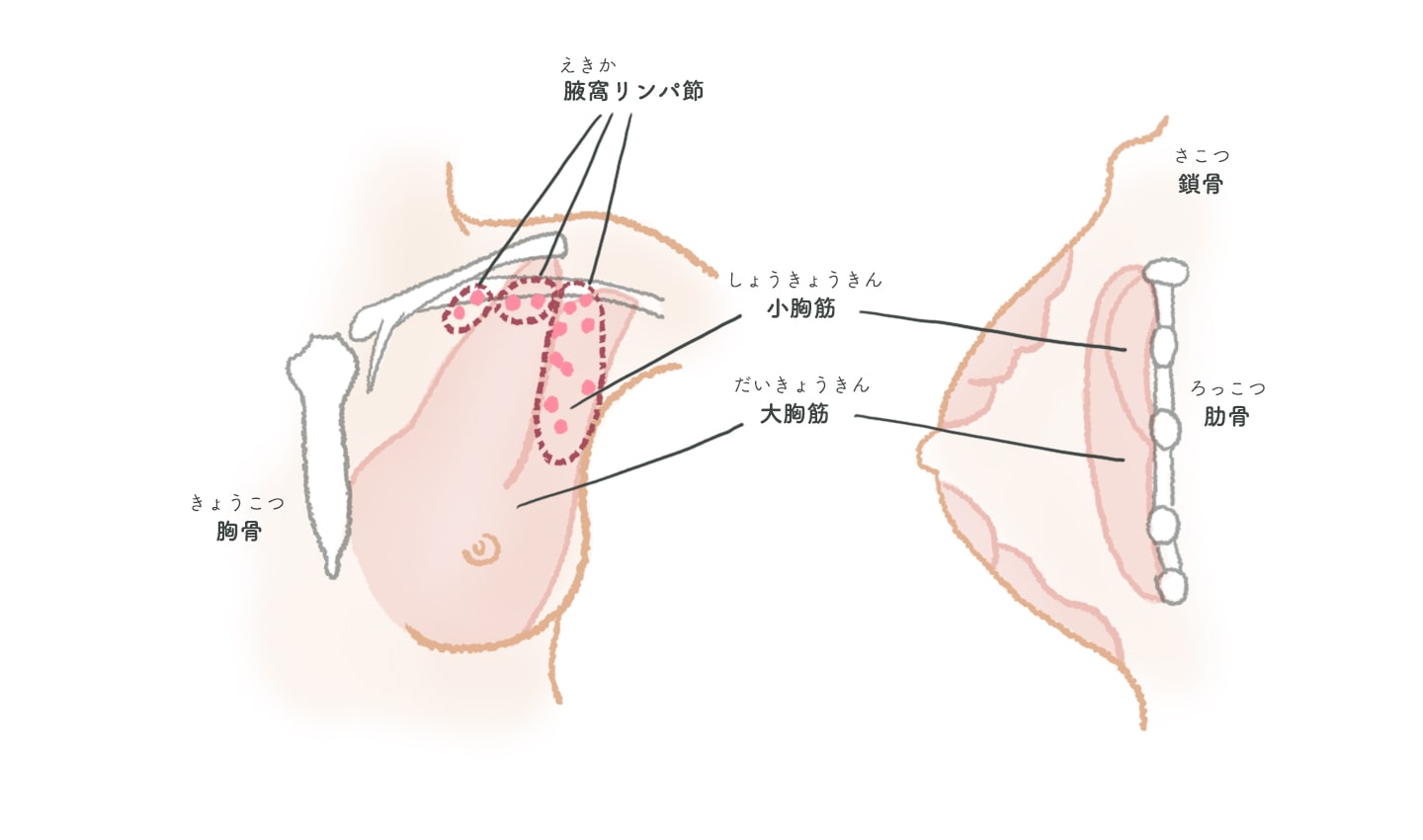 手術について | 治療をはじめる前に | ホルモン受容体陽性乳がん | 乳がん.jp